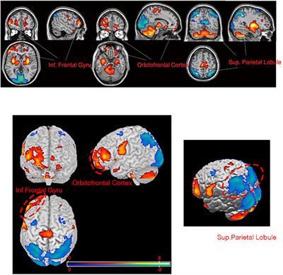 Effects of Bilateral Subthalamic Nucleus Stimulation on Depressive Symptoms and Cerebral Glucose Metabolism in Parkinson’s Disease: A 18F-Fluorodeoxyglucose Positron Emission Tomography/Computerized Tomography Study